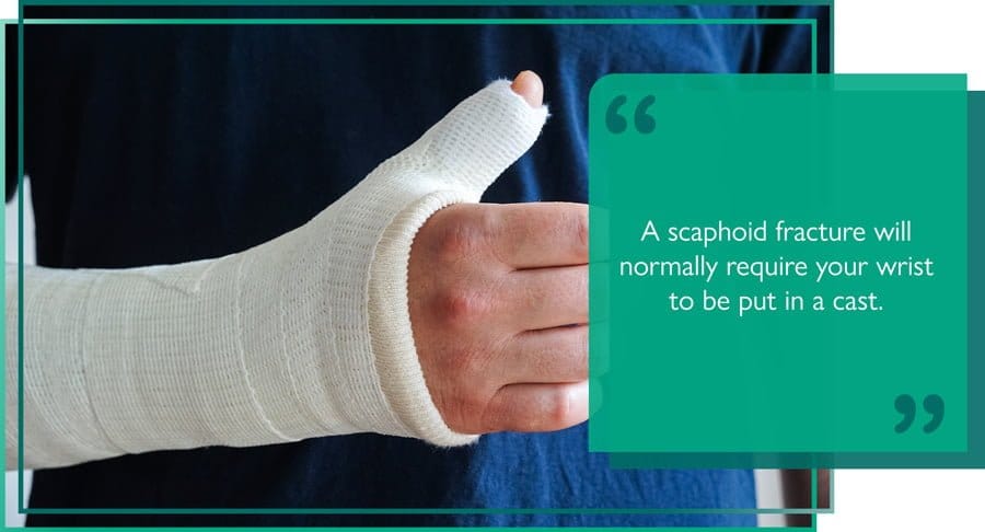 A patient with his wrist in a cast after being diagnosed with a previously untreated scaphoid fracture